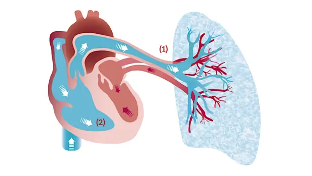 Schematische Darstellung des Blutflusses durch das Herz und die Lunge: (1) Sauerstoffarmes Blut fließt von der rechten Herzkammer in die Lunge, (2) sauerstoffreiches Blut fließt zurück in die linke Herzkammer und wird in den Körper gepumpt.