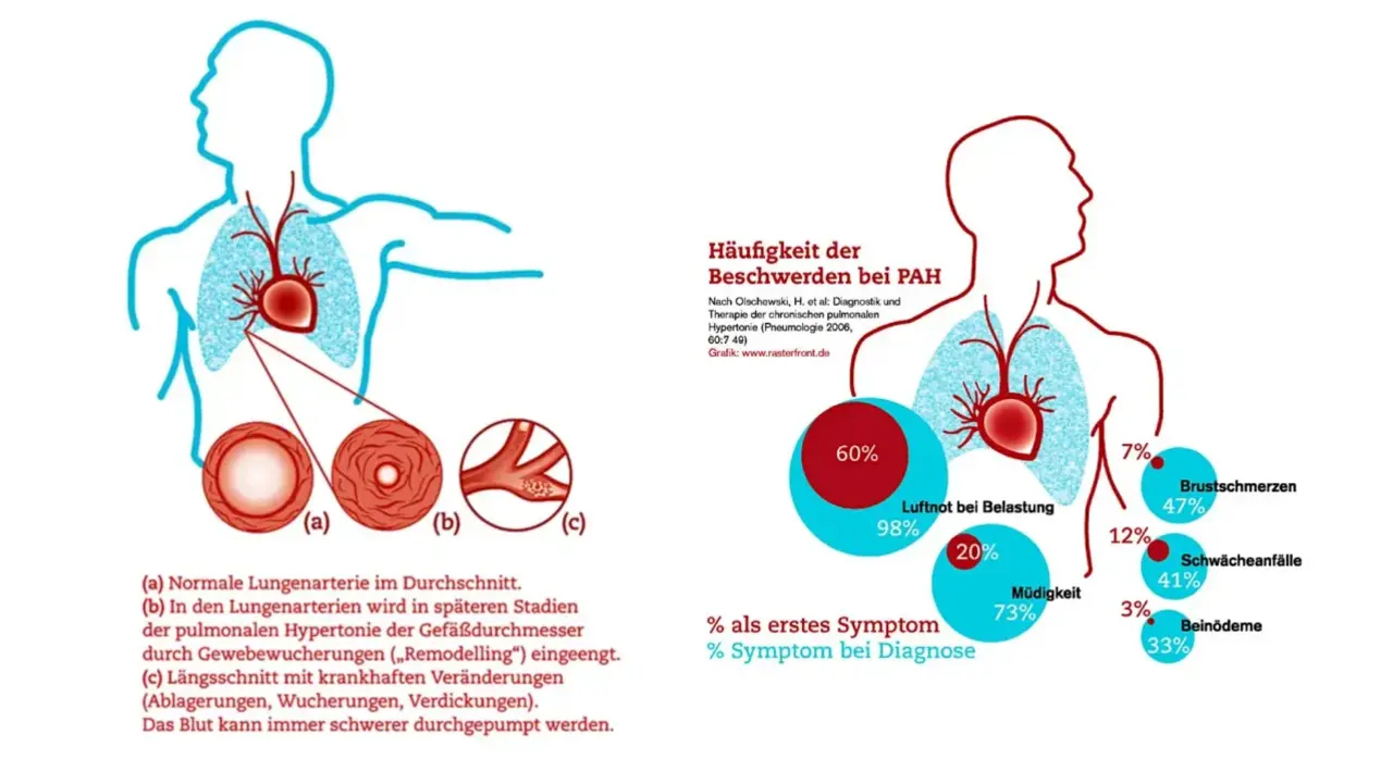 In der Mitte des Bildes ist der Oberkörper eines Menschen zu sehen, in dem das Herz und die Lunge abgebildet sind. Daneben werden drei Ansichten von Lungenarterien gezeigt: eine gesunde Arterie, eine verengte Arterie und eine stark erkrankte Arterie. Der Hintergrund zeigt Diagramme, die die häufigsten Symptome der Krankheit PAH (pulmonale arterielle Hypertonie) darstellen.